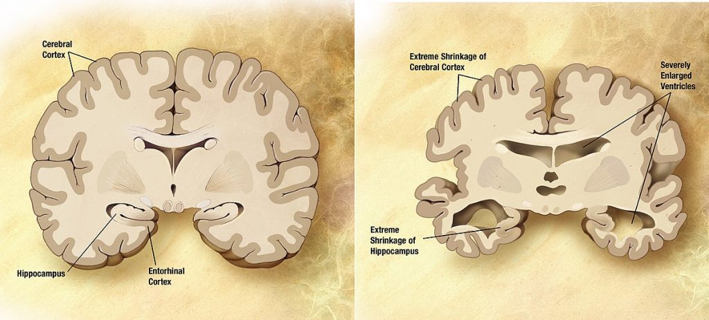 ピエトロスカドゥートとアルツハイマー病の研究